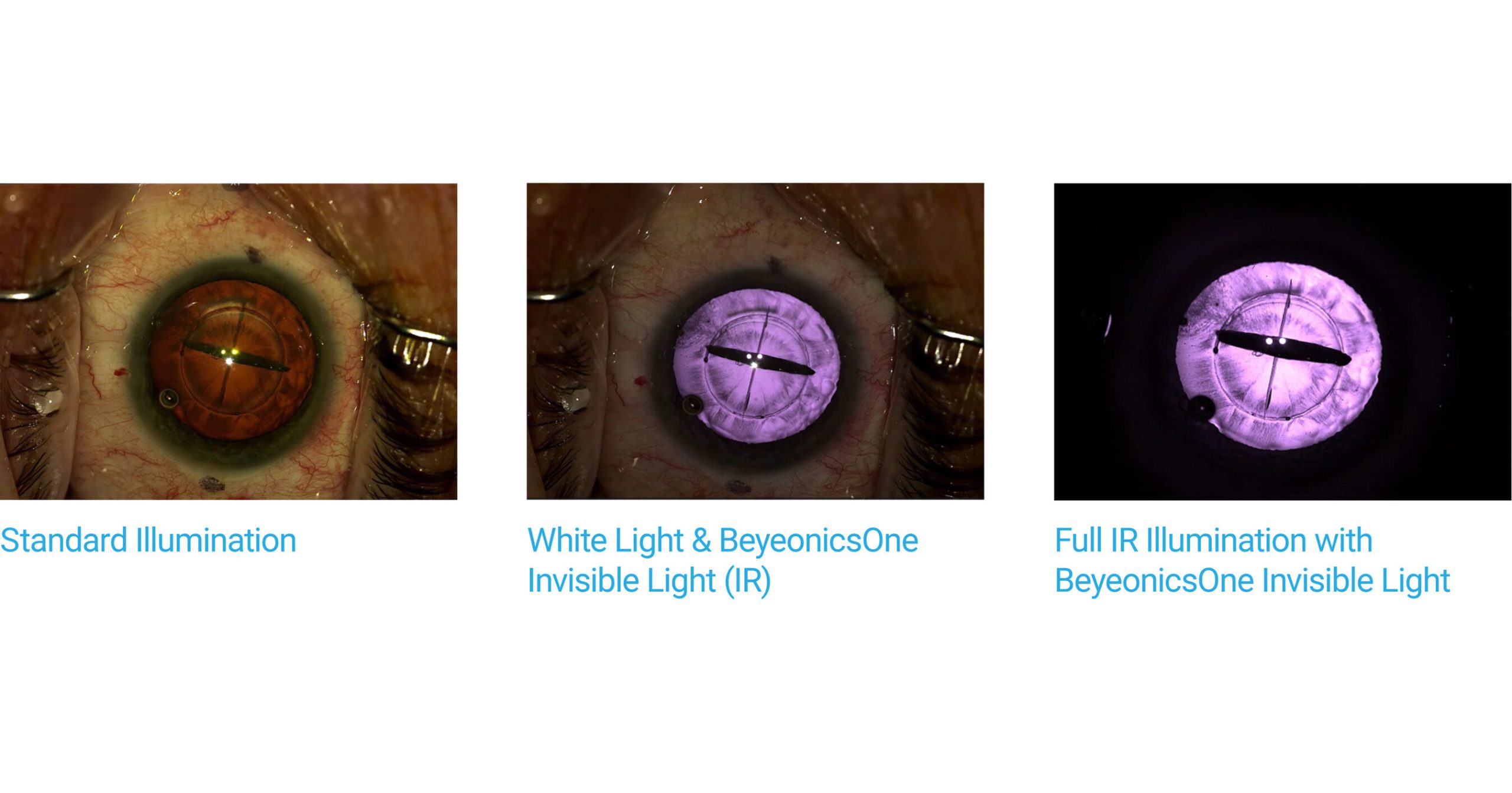 Beyeonics One Revolutionizes Ophthalmic Surgery with Invisible Light Technology [Video]