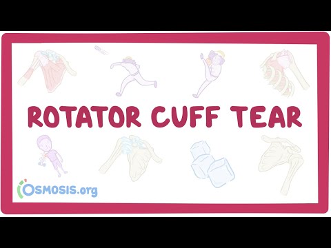 Rotator cuff tear [Video]