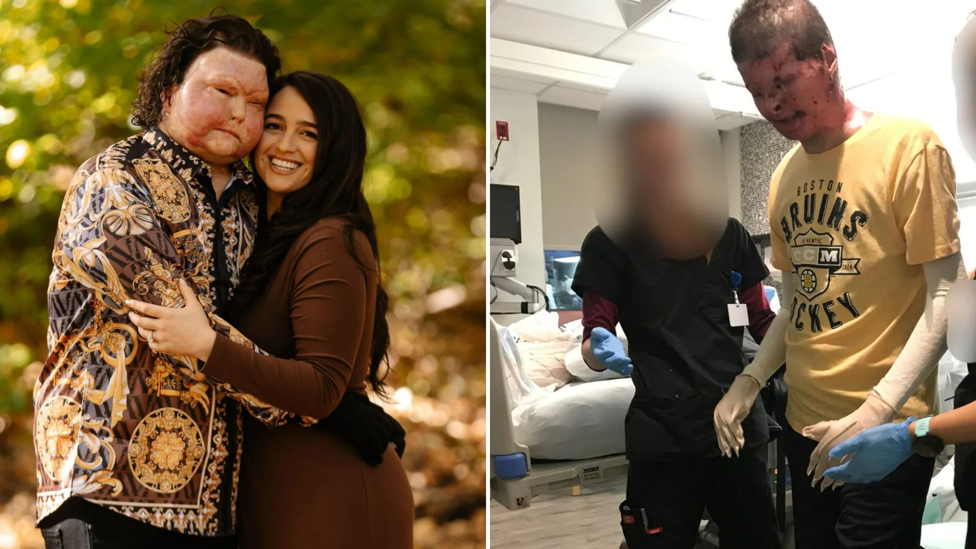 I’m marrying the man with the world’s first face transplant – teenagers taunt us & cruel trolls say Im a gold digger [Video]